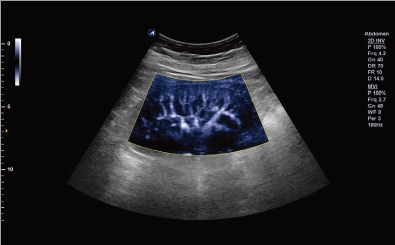 Kidney with MicroView
