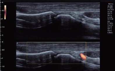 Finger in Power Doppler mode