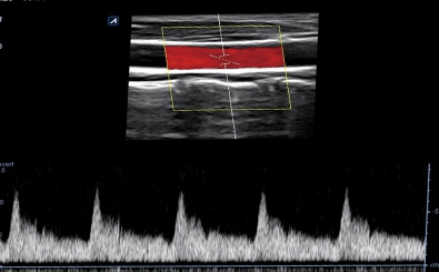 Carotid Artery