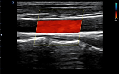 Carotid Artery
