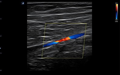 Peripheral Artery