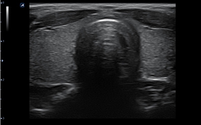 Thyroid