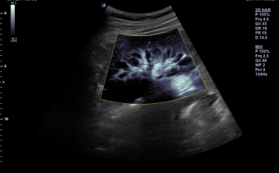 Kidney with MicroView
