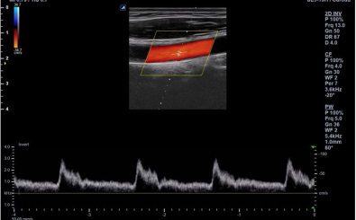 Carotid