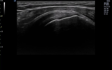 Shoulder