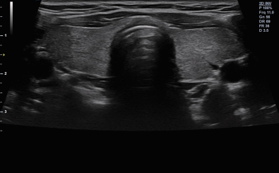 Thyroid