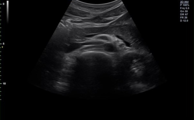 Pancreas