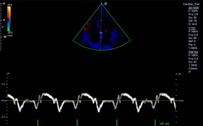 Cardiac in TDI mode