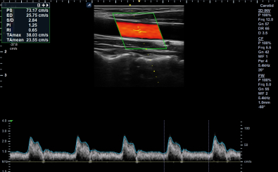 Carotid