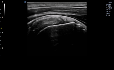 Shoulder