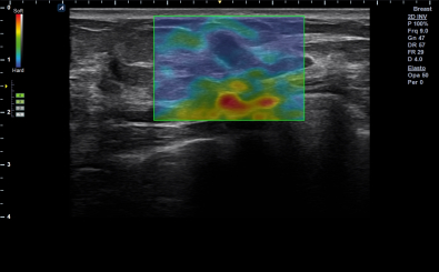 Strain Elastography