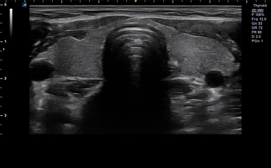 Thyroid