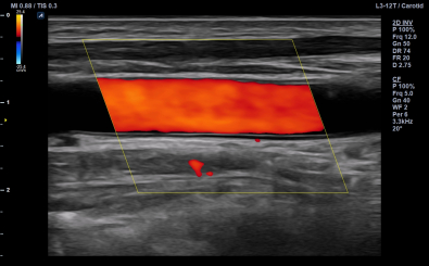 Carotid